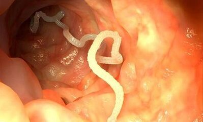 cauzele paraziților în corpul uman